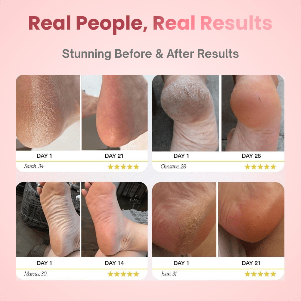 Nuri™ Electric Foot Callus Remover - Elanuri